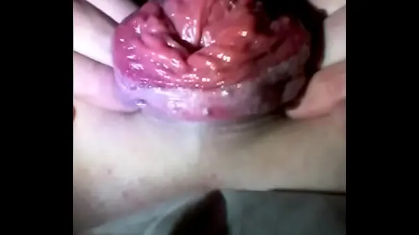 Anal prolapse पावर ट्यूब दिखाएँ